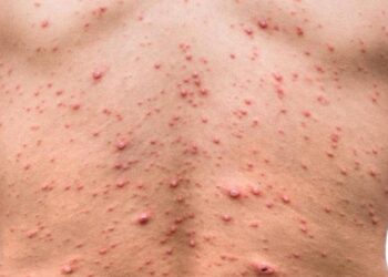 क्या है मंकी पॉक्स बीमारी प्रमुख लक्षण